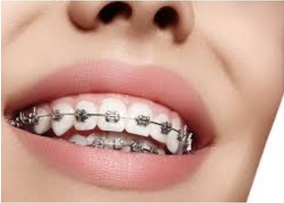 Tratamiento de ortodoncia con brackets